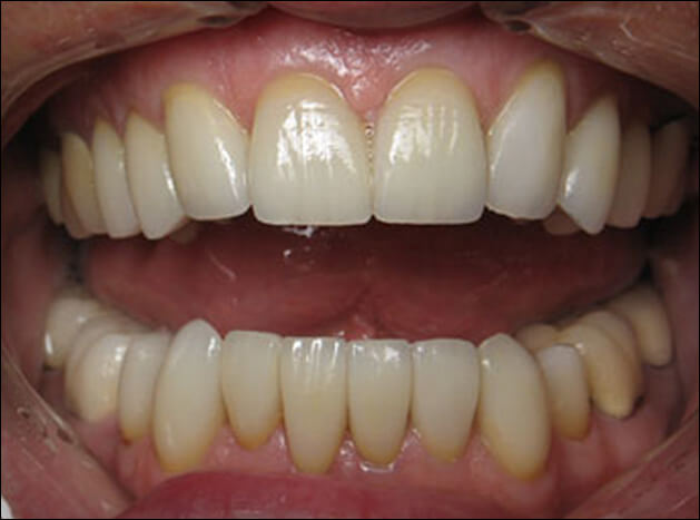 after 8 Upper & 7 Lower Veneers