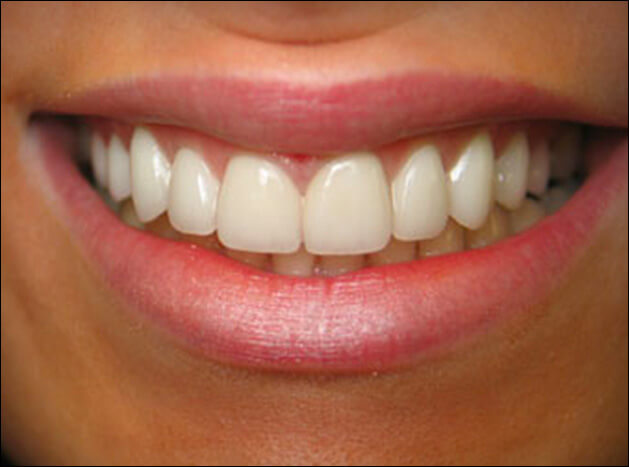 after 8 Veneers