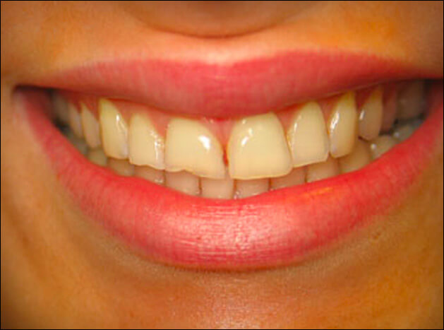 before 8 Veneers