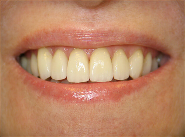 after Eight Upper Veneers