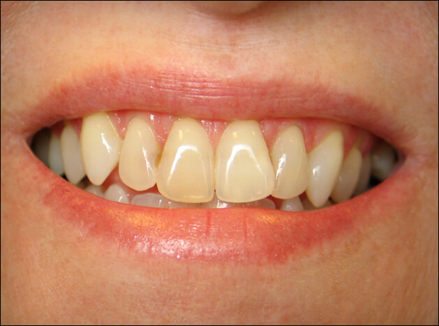 before Eight Upper Veneers