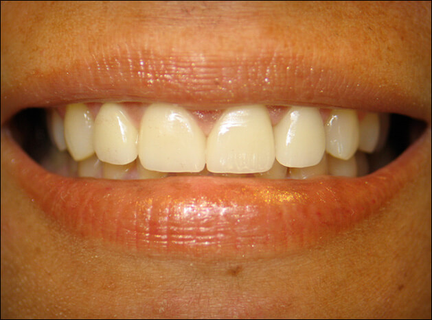 after Four Veneers 2 Close Space
