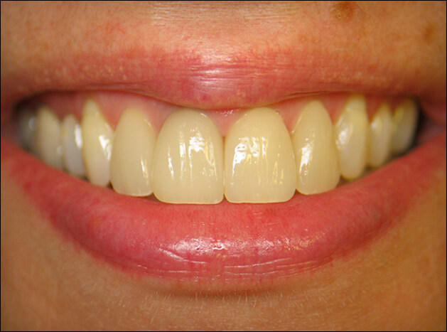 after Four Veneers