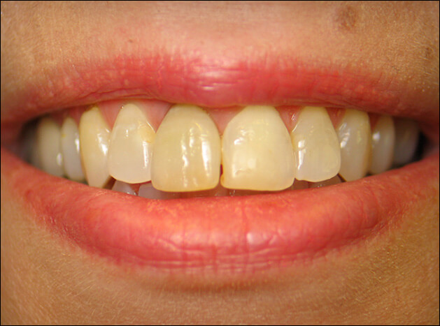 before Four Veneers