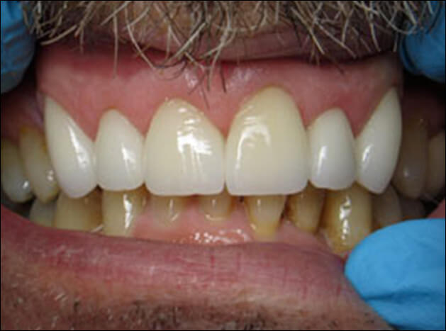 after Six Upper All Porcelain Crowns