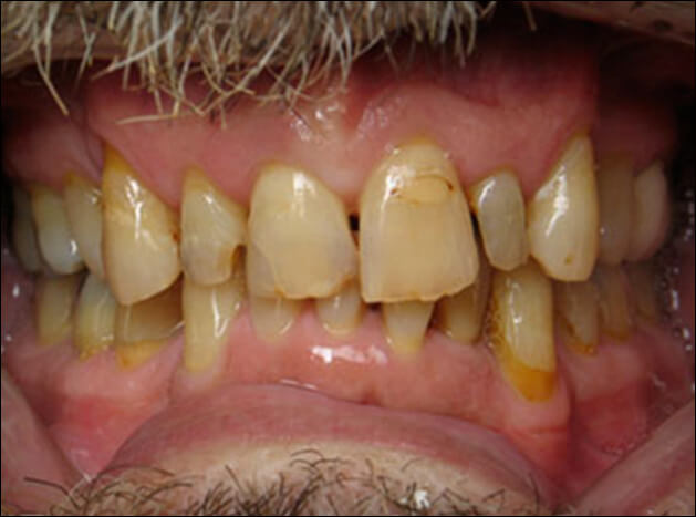 before Six Upper All Porcelain Crowns