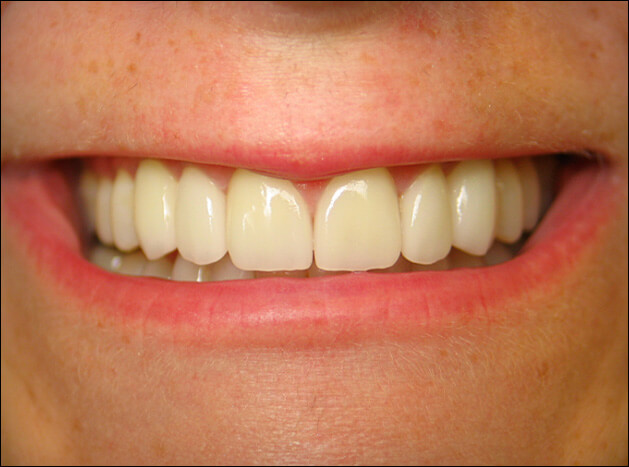 after Six Veneers