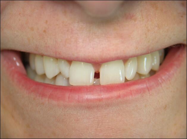 before Six Veneers