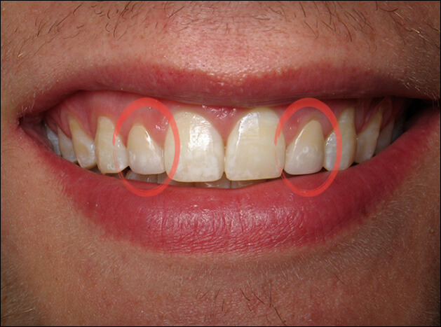 after Two Veneers on Lateral Incisors