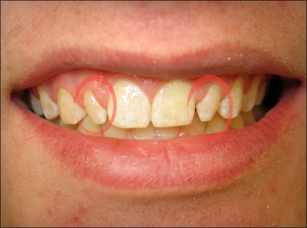 before Two Veneers on Lateral Incisors