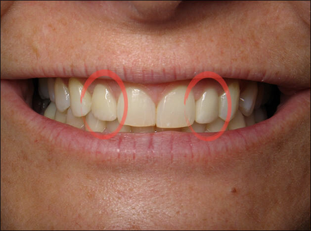 after Two Veneers on Lateral Incisors