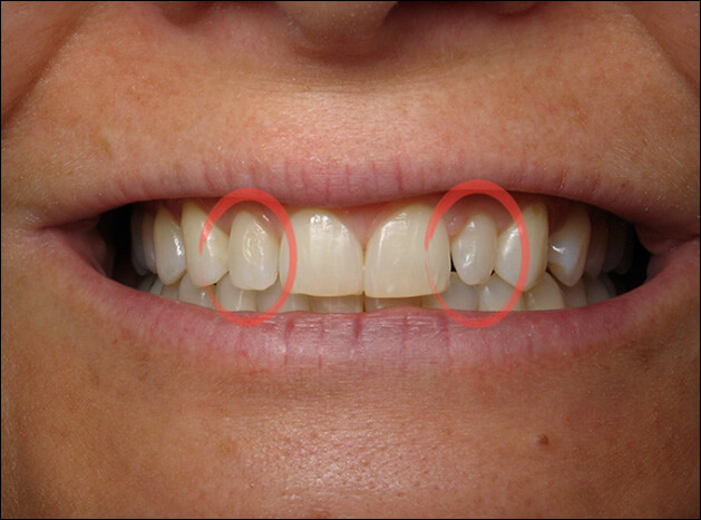 before Two Veneers on Lateral Incisors