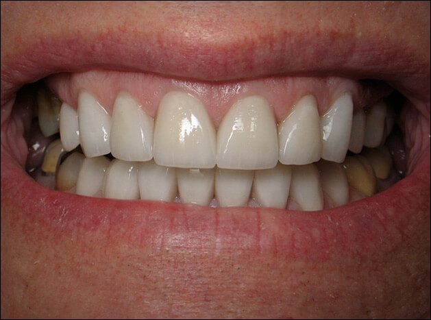 after Upper & Lower All Porcelain Crowns