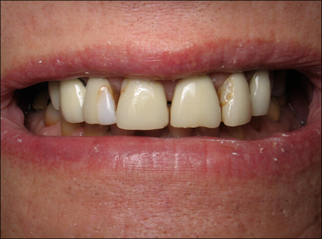 before Upper & Lower All Porcelain Crowns