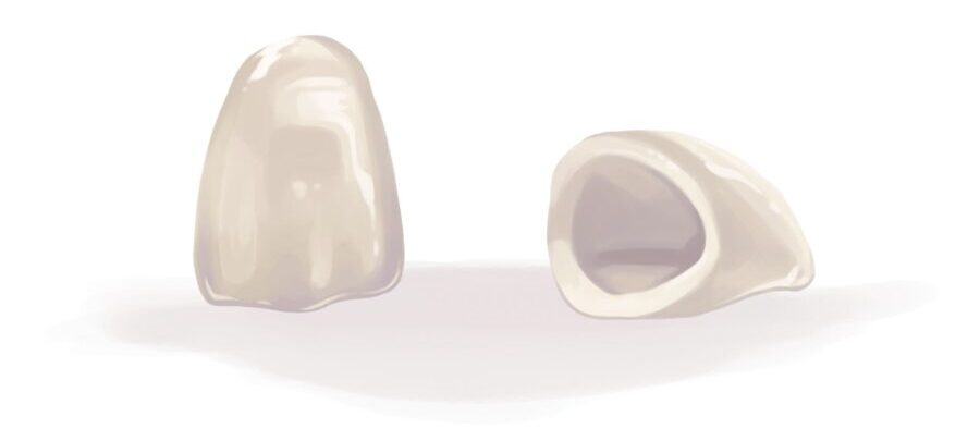 Illustration of 2 dental crowns