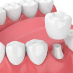 Closeup of a lower arch of teeth getting a dental crown to protect a damaged tooth