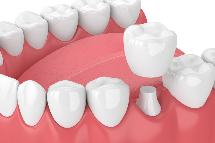 Closeup of a lower arch of teeth getting a dental crown to protect a damaged tooth