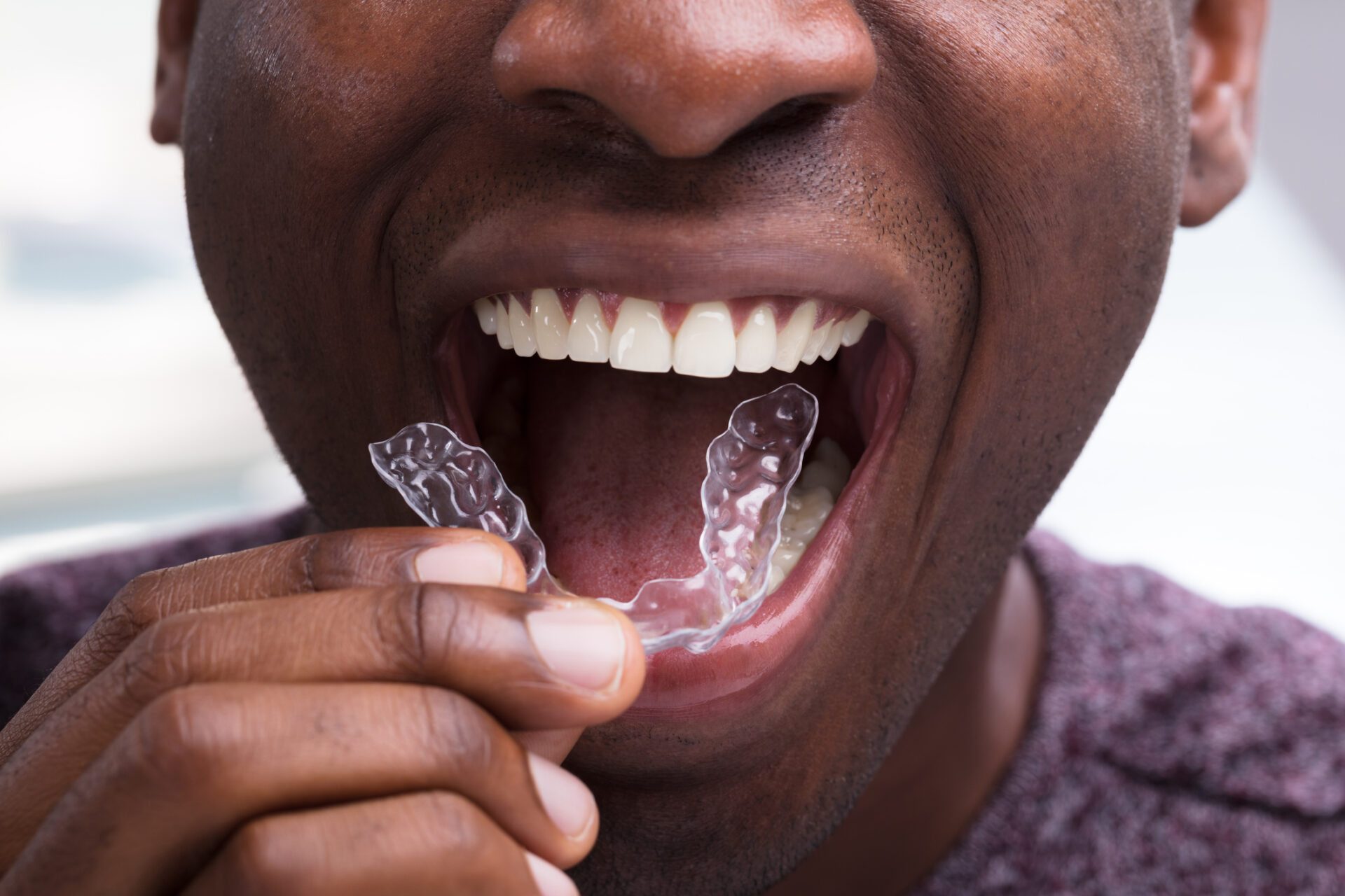 Invisalign alabama