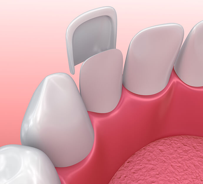 illustration of a dental veneer