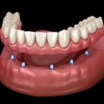 types of dentures, implant supported denture, removable denture, fixed denture, permanent denture