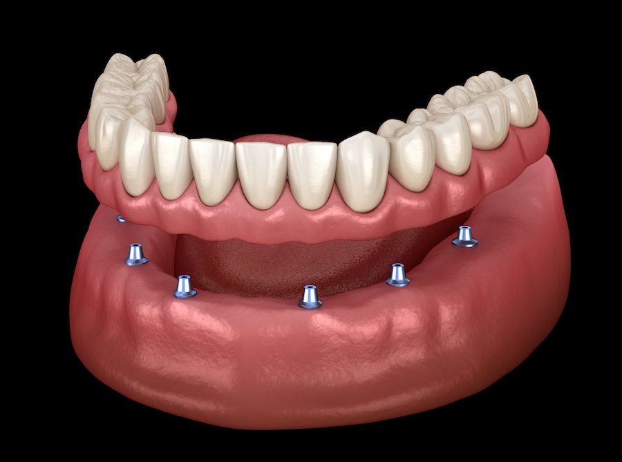 types of dentures, implant supported denture, removable denture, fixed denture, permanent denture