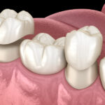 same-day dental crown, restorative dentistry