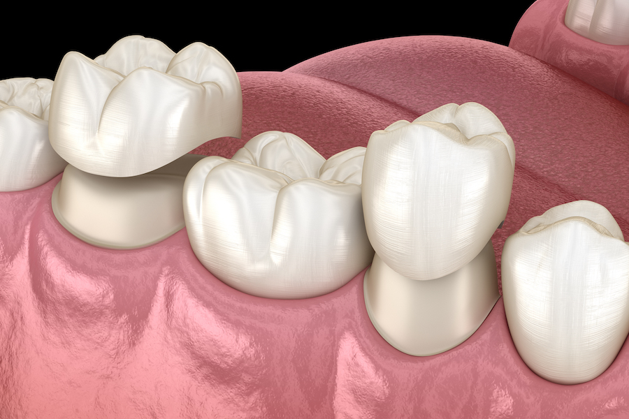 same-day dental crown, restorative dentistry