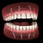 hybrid dentures illustration on dental implants