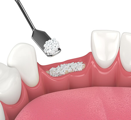 illustration of a bone graft procedure