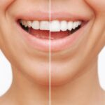 woman with dental veneers, are veneers permanent