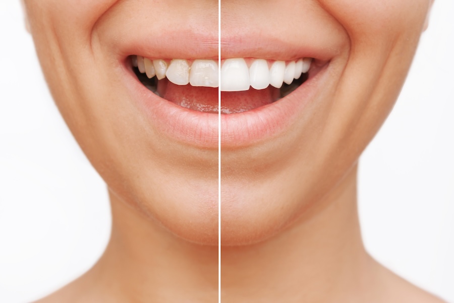 woman with dental veneers, are veneers permanent
