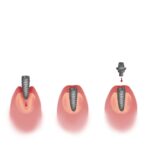 dental implant healing timeline
