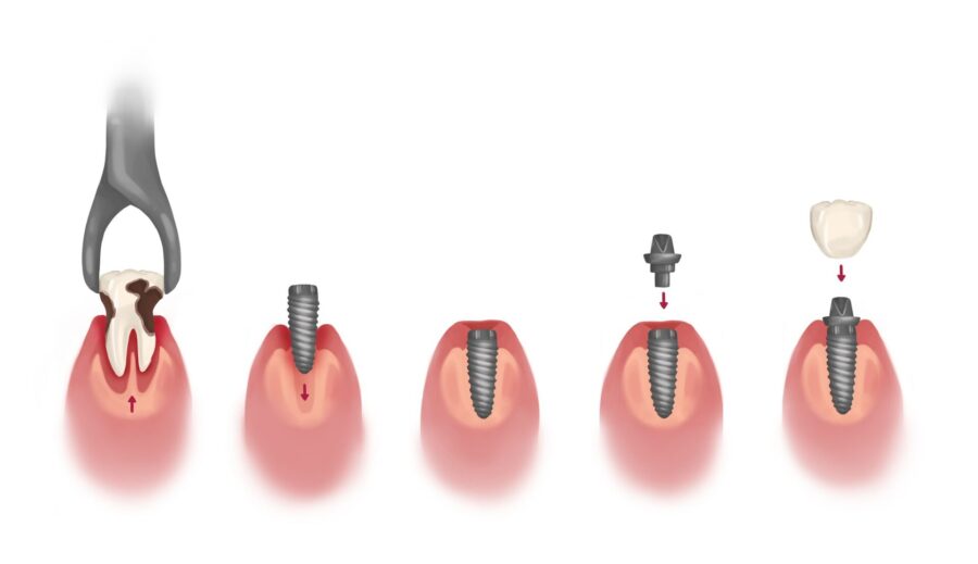 dental implant healing timeline